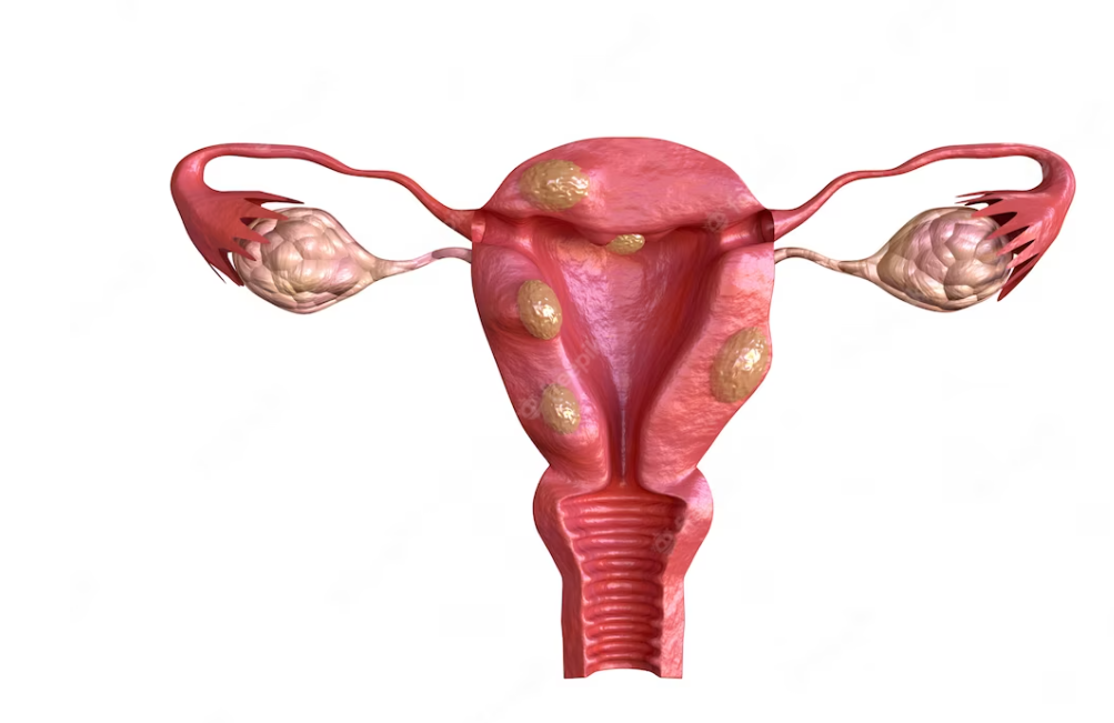 Rahim Ağzı Kanseri Tedavisi