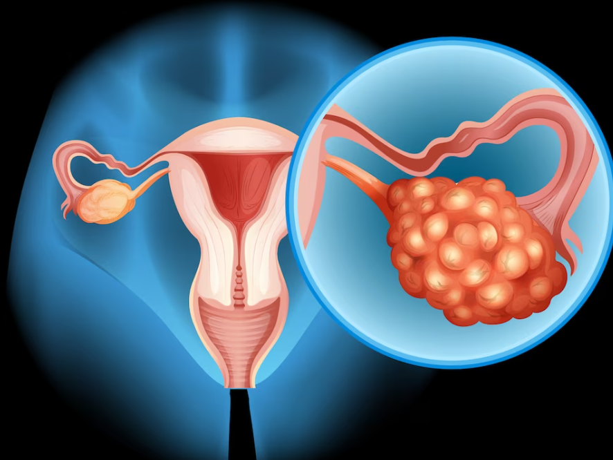Yumurtalik-Kisti-Tedavisi