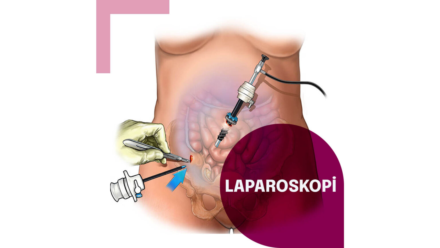 Laparoskopi hakkında