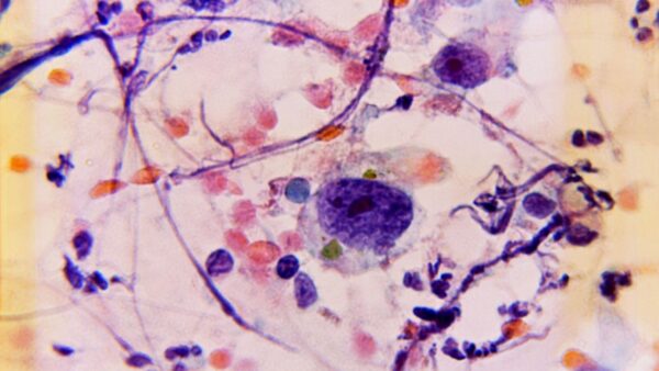 Rahim Kanseri 4. Evre Belirtileri